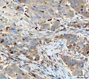 IHC staining of FFPE human urothelium carcinoma tissue with TRAC antibody. HIER: boil tissue sections in pH8 EDTA for 20 min and allow to cool before testing.