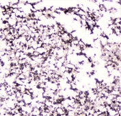 IHC staining of FFPE human glioma with UBC9 antibody at 1ug/ml. HIER: boil tissue sections in pH6, 10mM citrate buffer, for 10-20 min followed by cooling at RT for 20 min.