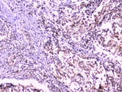 IHC staining of FFPE human lung cancer with UBC9 antibody at 1ug/ml. HIER: boil tissue sections in pH6, 10mM citrate buffer, for 10-20 min followed by cooling at RT for 20 min.