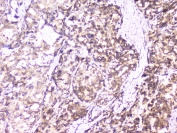 IHC staining of FFPE human stomach cancer with UBC9 antibody at 1ug/ml. HIER: boil tissue sections in pH6, 10mM citrate buffer, for 10-20 min followed by cooling at RT for 20 min.