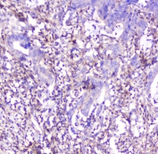 IHC staining of FFPE human colon cancer with ADA antibody at 1ug/ml. HIER: boil tissue sections in pH6, 10mM citrate buffer, for 10-20 min followed by cooling at RT for 20 min.