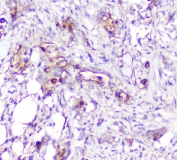 IHC staining of FFPE human rectal cancer with ADA antibody at 1ug/ml. HIER: boil tissue sections in pH6, 10mM citrate buffer, for 10-20 min followed by cooling at RT for 20 min.
