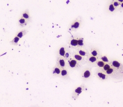 ICC staining of FFPE human A431 cells with NONO antibody at 1ug/ml. HIER: boil tissue sections in pH6, 10mM citrate buffer, for 10-20 min followed by cooling at RT for 20 min.