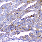 IHC staining of FFPE human colon cancer with CD2AP antibody at 1ug/ml. HIER: boil tissue sections in pH6, 10mM citrate buffer, for 10-20 min followed by cooling at RT for 20 min.