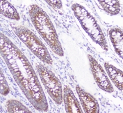IHC staining of FFPE human colon cancer with CD2AP antibody at 1ug/ml. HIER: boil tissue sections in pH6, 10mM citrate buffer, for 10-20 min followed by cooling at RT for 20 min.
