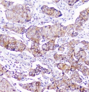 IHC staining of FFPE human breast cancer with CD2AP antibody at 1ug/ml. HIER: boil tissue sections in pH6, 10mM citrate buffer, for 10-20 min followed by cooling at RT for 20 min.