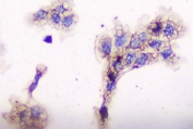 Immunocytochemical staining of FFPE human A431 cells with CD2AP antibody at 1ug/ml. HIER: boil tissue sections in pH6, 10mM citrate buffer, for 10-20 min followed by cooling at RT for 20 min.