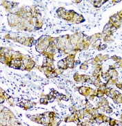 IHC staining of FFPE human breast cancer with CD2AP antibody at 1ug/ml. HIER: boil tissue sections in pH6, 10mM citrate buffer, for 10-20 min followed by cooling at RT for 20 min.