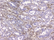 IHC staining of FFPE human intestinal cancer with B2M antibody. HIER: boil tissue sections in pH8 EDTA for 20 min and allow to cool before testing.