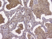 IHC staining of FFPE human lung cancer with B2M antibody. HIER: boil tissue sections in pH8 EDTA for 20 min and allow to cool before testing.