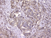 IHC staining of FFPE human breast cancer with B2M antibody. HIER: boil tissue sections in pH8 EDTA for 20 min and allow to cool before testing.
