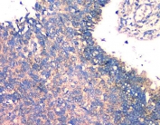 IHC staining of FFPE human lung cancer with FH antibody. HIER: boil tissue sections in pH8 EDTA for 20 min and allow to cool before testing.