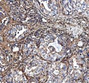 IHC staining of FFPE human lung adenocarcinoma tissue with COL3A1 antibody. HIER: boil tissue sections in pH8 EDTA for 20 min and allow to cool before testing.