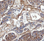 IHC staining of FFPE human liver cancer tissue with COL3A1 antibody. HIER: boil tissue sections in pH8 EDTA for 20 min and allow to cool before testing.