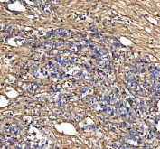 IHC staining of FFPE human gastric poorly differentiated adenocarcinoma tissue with COL3A1 antibody. HIER: boil tissue sections in pH8 EDTA for 20 min and allow to cool before testing.