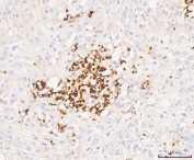 IHC staining of FFPE human bladder urothelial carcinoma tissue with Grancalcin antibody. HIER: boil tissue sections in pH8 EDTA for 20 min and allow to cool before testing.