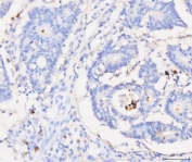 IHC staining of FFPE human colorectal adenocarcinoma tissue with Grancalcin antibody. HIER: boil tissue sections in pH8 EDTA for 20 min and allow to cool before testing.