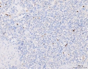 IHC staining of FFPE human lung cancer tissue with Grancalcin antibody. HIER: boil tissue sections in pH8 EDTA for 20 min and allow to cool before testing.