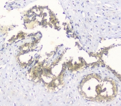 IHC staining of FFPE human breast cancer with HAS1 antibody at 1ug/ml. HIER: boil tissue sections in pH6, 10mM citrate buffer, for 10-20 min and allow to cool before testing.