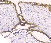 IHC staining of FFPE human breast cancer with HAS1 antibody at 1ug/ml. HIER: boil tissue sections in pH6, 10mM citrate buffer, for 10-20 min and allow to cool before testing.