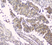 IHC staining of FFPE human lung cancer with HAS1 antibody at 1ug/ml. HIER: boil tissue sections in pH6, 10mM citrate buffer, for 10-20 min and allow to cool before testing.