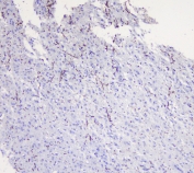 IHC staining of FFPE human glioma with MOG antibody at 1ug/ml. HIER: boil tissue sections in pH6, 10mM citrate buffer, for 10-20 min followed by cooling at RT for 20 min.