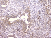 IHC staining of FFPE human rectal cancer with PCDH15 antibody at 1ug/ml. HIER: boil tissue sections in pH6, 10mM citrate buffer, for 10-20 min followed by cooling at RT for 20 min.