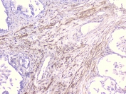 IHC staining of FFPE human prostate cancer with PCDH15 antibody at 1ug/ml. HIER: boil tissue sections in pH6, 10mM citrate buffer, for 10-20 min followed by cooling at RT for 20 min.