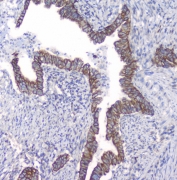 IHC staining of FFPE human intestinal cancer with PKC beta antibody at 1ug/ml. HIER: boil tissue sections in pH6, 10mM citrate buffer, for 10-20 min followed by cooling at RT for 20 min.