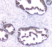 IHC staining of FFPE human prostate cancer with PKC beta antibody at 1ug/ml. HIER: boil tissue sections in pH6, 10mM citrate buffer, for 10-20 min followed by cooling at RT for 20 min.