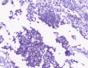 IHC staining of FFPE human glioma with PKC gamma antibody at 1ug/ml. HIER: boil tissue sections in pH6, 10mM citrate buffer, for 10-20 min followed by cooling at RT for 20 min.