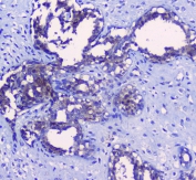 IHC staining of FFPE human breast cancer with SRI antibody at 1ug/ml. HIER: boil tissue sections in pH6, 10mM citrate buffer, for 10-20 min followed by cooling at RT for 20 min.
