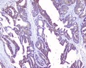 IHC staining of FFPE human intestinal cancer with SRI antibody at 1ug/ml. HIER: boil tissue sections in pH6, 10mM citrate buffer, for 10-20 min followed by cooling at RT for 20 min.
