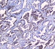 IHC staining of FFPE human lung cancer with SRI antibody at 1ug/ml. HIER: boil tissue sections in pH6, 10mM citrate buffer, for 10-20 min followed by cooling at RT for 20 min.