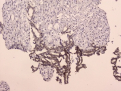 IHC staining of FFPE human breast cancer with LRIG1 antibody at 2ug/ml. HIER: boil tissue sections in pH6, 10mM citrate buffer, for 10-20 min followed by cooling at RT for 20 min.