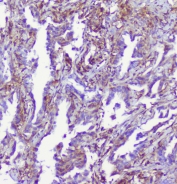 IHC staining of FFPE human lung cancer with RP2 antibody at 1ug/ml. HIER: boil tissue sections in pH6, 10mM citrate buffer, for 10-20 min followed by cooling at RT for 20 min.