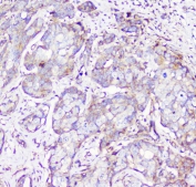 IHC staining of FFPE human breast cancer with RP2 antibody at 1ug/ml. HIER: boil tissue sections in pH6, 10mM citrate buffer, for 10-20 min followed by cooling at RT for 20 min.