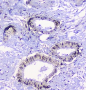 IHC staining of FFPE human cholangiocarcinoma with Properdin antibody at 1ug/ml. HIER: boil tissue sections in pH6, 10mM citrate buffer, for 10-20 min followed by cooling at RT for 20 min.
