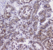 IHC staining of FFPE human liver cancer with Properdin antibody at 1ug/ml. HIER: boil tissue sections in pH6, 10mM citrate buffer, for 10-20 min followed by cooling at RT for 20 min.
