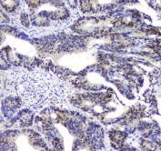 IHC testing of FFPE human intestinal cancer wtih p62 antibody. HIER: Boil the paraffin sections in pH 6, 10mM citrate buffer for 20 minutes and allow to cool prior to staining.