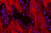 Immunofluorescent staining of human lung cancer tissue with p62 antibody (red)  at 1ug/ml and DAPI counterstain. HIER: boil tissue sections in pH6, 10mM citrate buffer, for 10-20 min and allow to cool before testing.