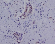 IHC staining of FFPE human prostate carcinoma with AR-V7 antibody. HIER: boil tissue sections in pH6, 10mM citrate buffer, for 10-20 min and allow to cool before testing.
