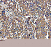 IHC staining of FFPE human ovarian serous adenocarcinoma tissue with ADAM10 antibody, HRP-secondary and DAB substrate. HIER: boil tissue sections in pH8 EDTA for 20 min and allow to cool before testing.