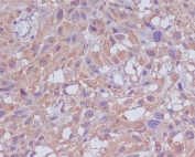 IHC staining of FFPE human melanoma with Neuropilin 1 antibody. HIER: boil tissue sections in pH6, 10mM citrate buffer, for 10-20 min and allow to cool before testing.