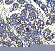 IHC staining of FFPE human skin cancer tissue with p73 antibody, HRP-labeled secondary and DAB substrate. HIER: boil tissue sections in pH8 EDTA for 20 min and allow to cool before testing.