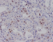 IHC staining of FFPE human gastric carcinoma with BIRC5 antibody. HIER: boil tissue sections in pH6, 10mM citrate buffer, for 10-20 min and allow to cool before testing.