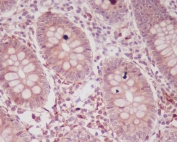 IHC staining of FFPE human colon tissue with p16 ARC antibody. HIER: boil tissue sections in pH6, 10mM citrate buffer, for 10-20 min and allow to cool before testing.