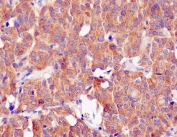 IHC staining of human thyroid carcinoma with CLOCK antibody. HIER: boil tissue sections in pH6, 10mM citrate buffer, for 10-20 min and allow to cool before testing.