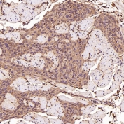 IHC staining of FFPE human esophageal carcinoma tissue with BCL2L11 antibody. HIER: boil tissue sections in pH6, 10mM citrate buffer, for 10-20 min and allow to cool before testing.