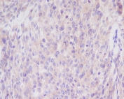 IHC staining of FFPE human cervix with BCL2L11 antibody. HIER: boil tissue sections in pH6, 10mM citrate buffer, for 10-20 min and allow to cool before testing.
